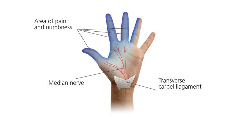 https://www.southtees.nhs.uk/wp-content/uploads/2022/07/carpal-tunnel-diagram-800x400.jpg