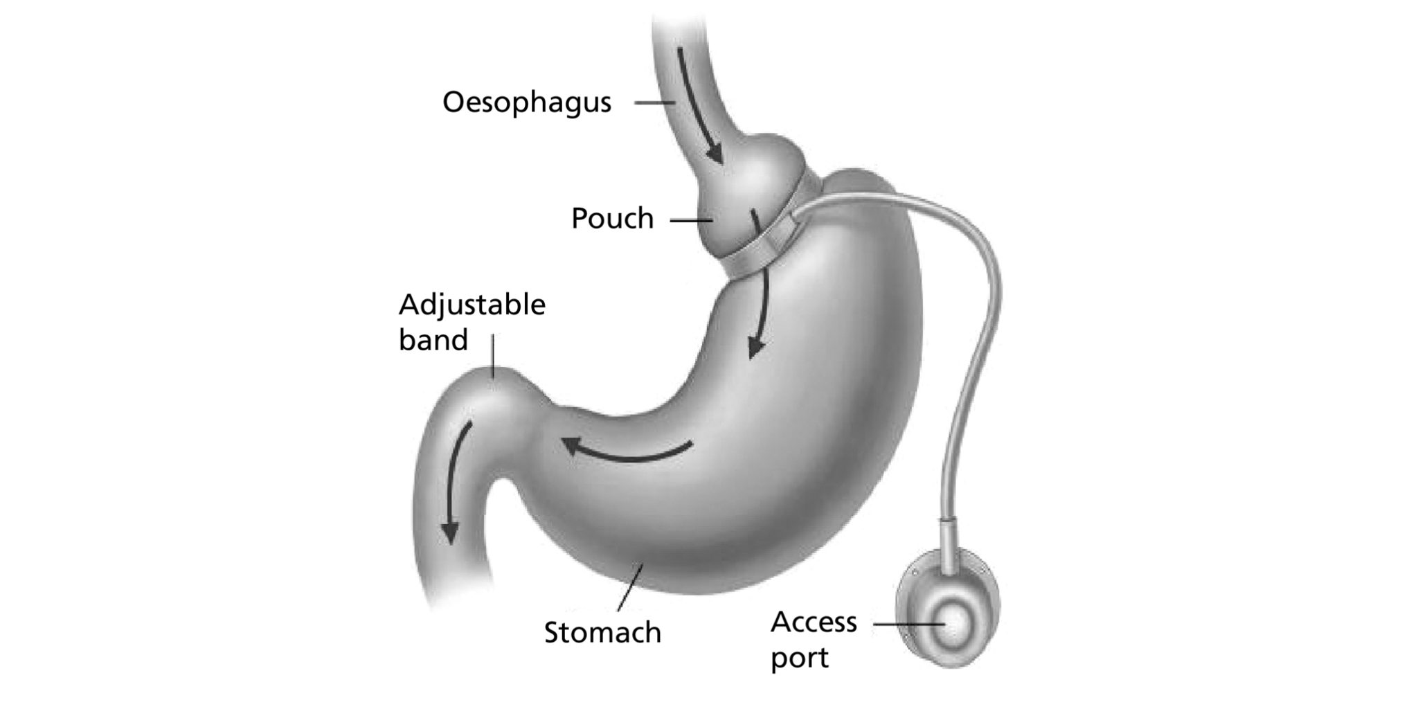 Laparoscopic gastric band (post procedure) South Tees Hospitals NHS