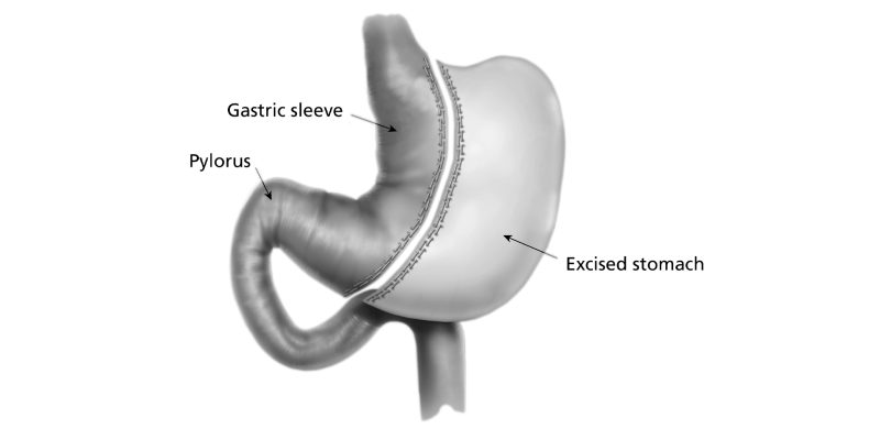 Diagram illustrating the area of the stomach that will be reduced