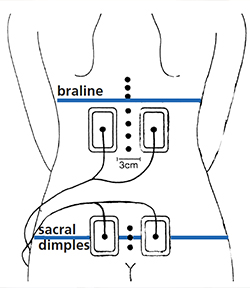 Using a TENS machine during labour