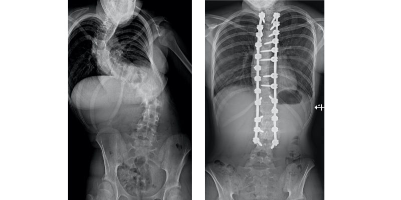 xray showing the curved spine alongside an xray of the spine after the surgery showing the metalwork in place along the spine.