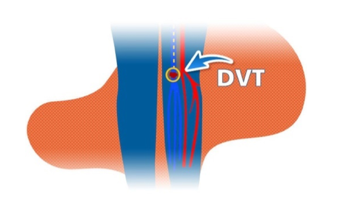 Diagram of legs highlighting veined area where a DVT blood clot could occur