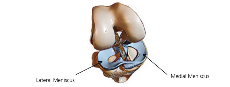 Diagram of the knee joint with arrows pointing to the lateral meniscus (left side) and the medial meniscus (right side)
