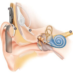 illustration of the ear highlighting where the implant would sit