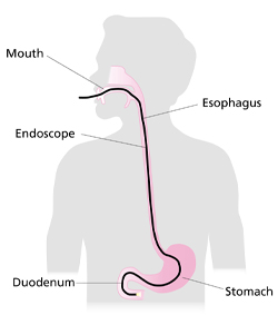 illustration showing the flexible tube going in from the mouth and down the esophagus into the stomach to the duodenum