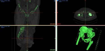 Producing a 3D pelvis