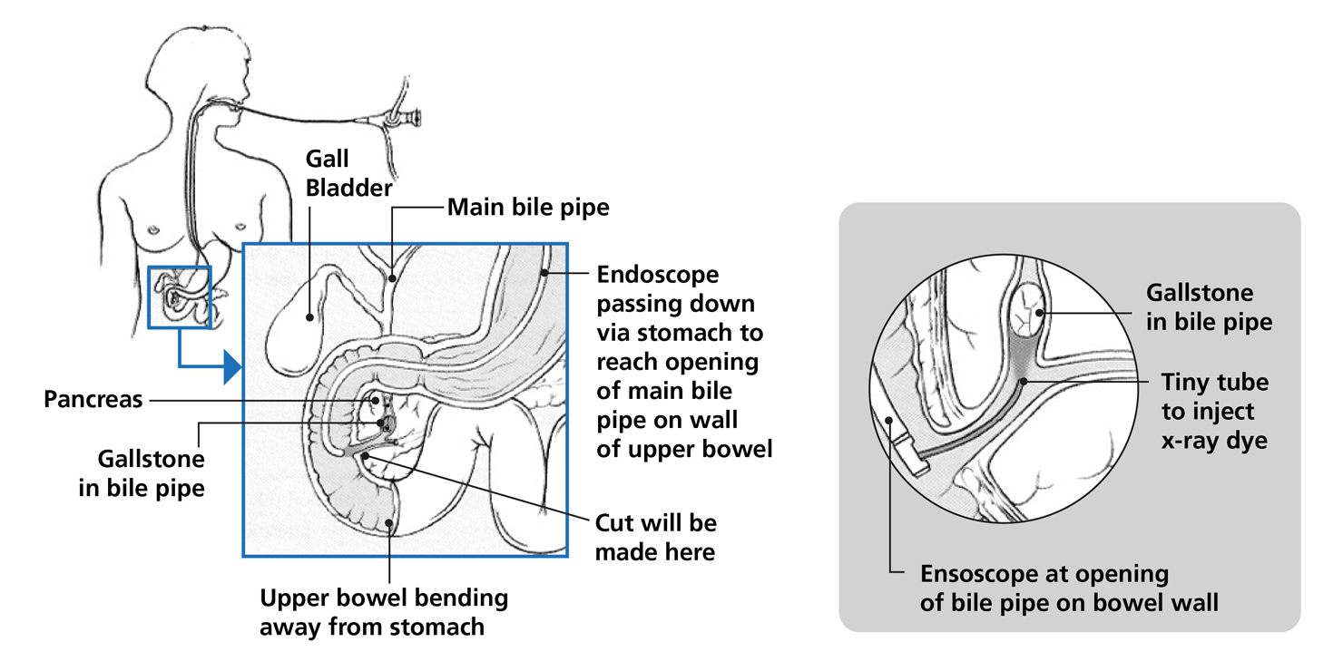 Endoscopic Retrograde Cholangio-Pancreatography (ERCP) - South Tees ...