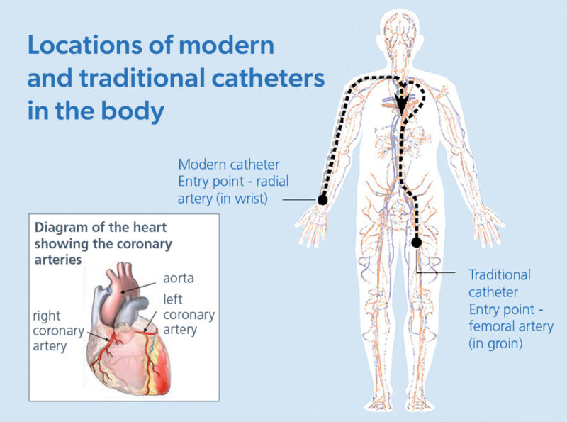 Diagram showing the location of modern and traditional catheter points (wrist and groin)