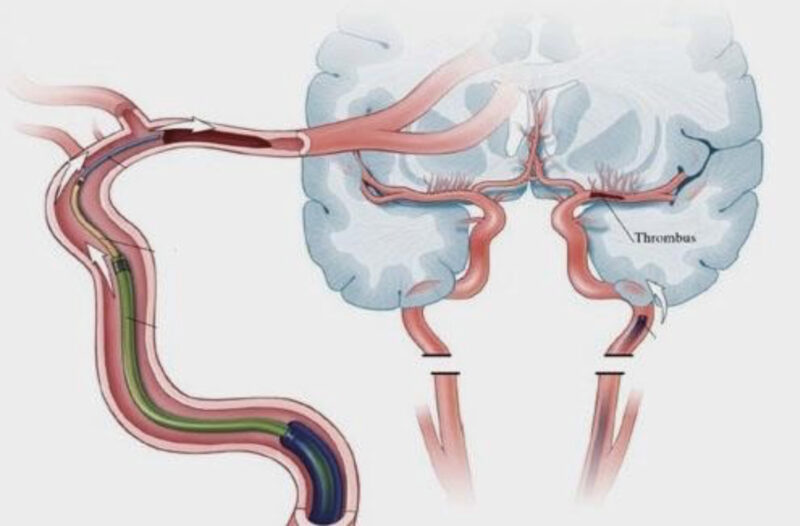 Image showing the blood clot ‘thrombus’ causing the stroke, and the guide wire going up the vessel to reach and remove the clot. 