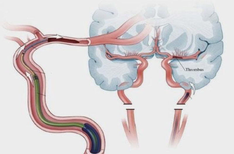 Image showing the blood clot ‘thrombus’ causing the stroke, and the guide wire going up the vessel to reach and remove the clot.