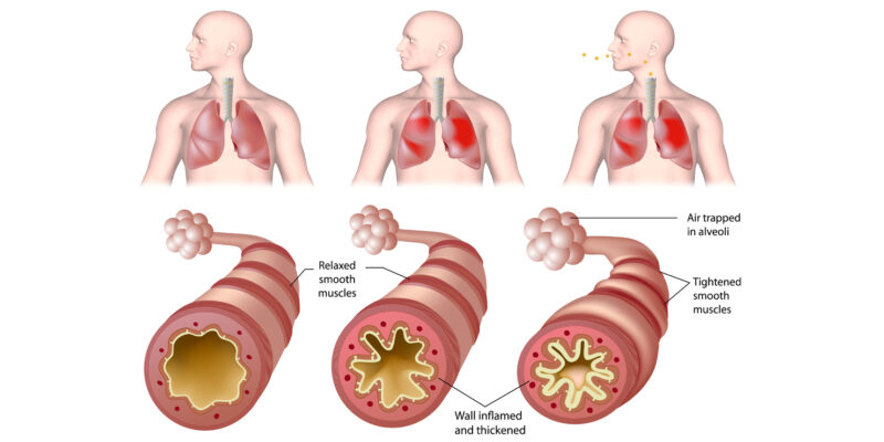 Diagram showing the airway without asthma alongside the airway when you have asthma