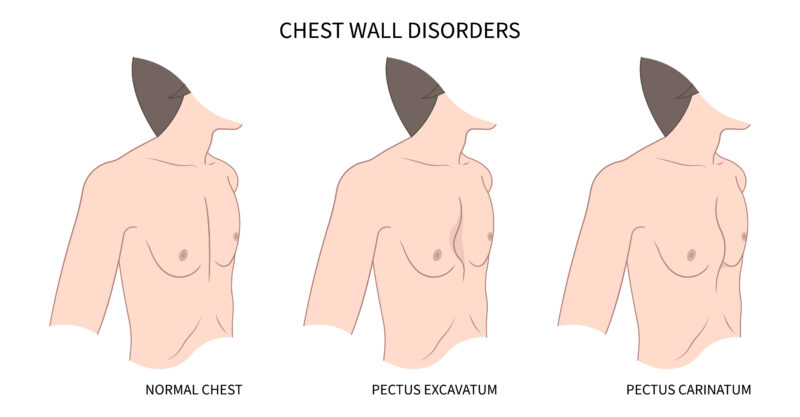Chest Wall disorders
