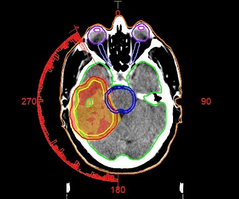 Radiotherapy image