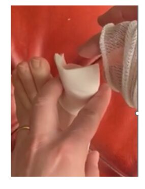 Image showing the placement of a pad on the toe.