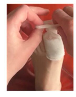 Image showing how to apply tubular dressing to the toe.