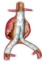 Metal stent