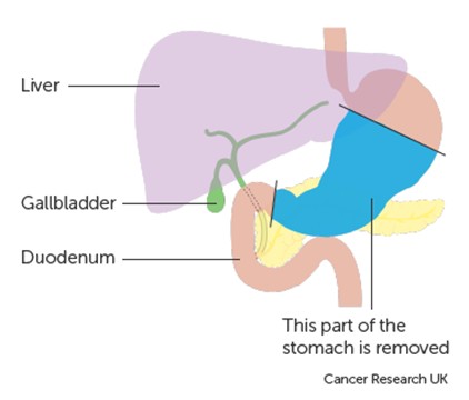 Image showing which part of the stomach is to be removed.