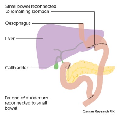 Image showing where the bowel is reconnected to the remaining stomach.