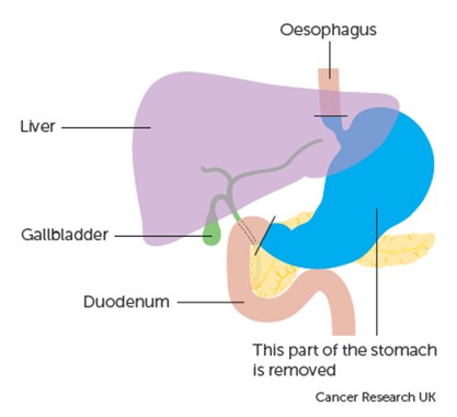 Image showing the whole stomach removed.