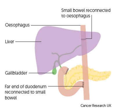 Image showing where the bowel is reconnected following removal of the stomach.