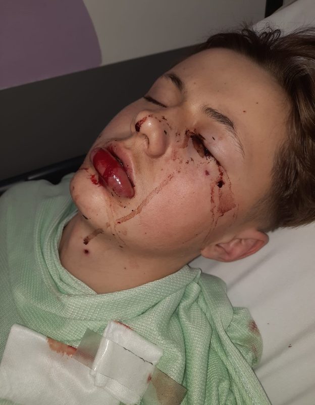 Aleks after his accident