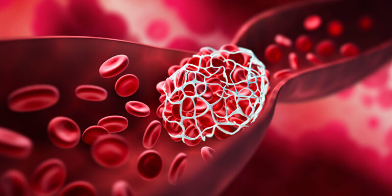 Blood clot blocking a blood vessel