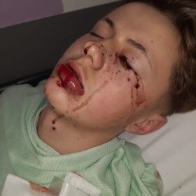 Aleks after his accident