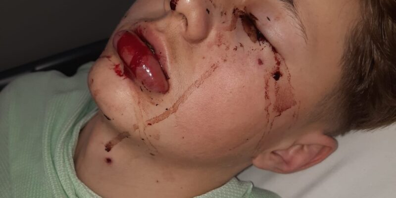 Aleks after his accident