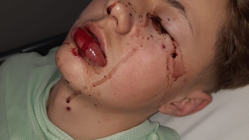 Aleks after his accident